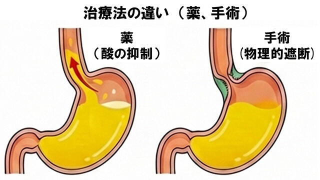 逆流性食道炎の治療メカニズムの比較。薬物療法による胃酸抑制と、手術による物理的な逆流防止の違い。