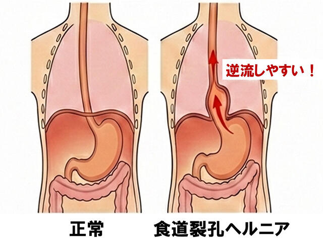 正常な胃と食道裂孔ヘルニアの解剖図。横隔膜から胃の一部が胸腔へ脱出している状態の比較。