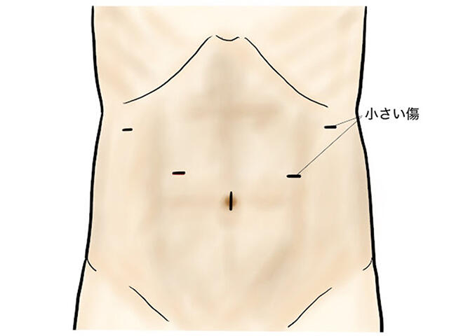 腹腔鏡下食道裂孔ヘルニア手術における一般的な傷口の位置（5箇所）と、傷の小ささを示すイラスト。